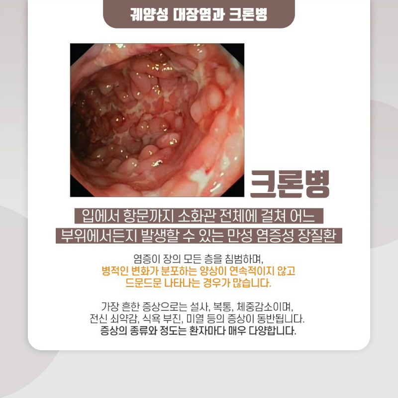 [소화기내과] 염증성장질환 4.jpg
