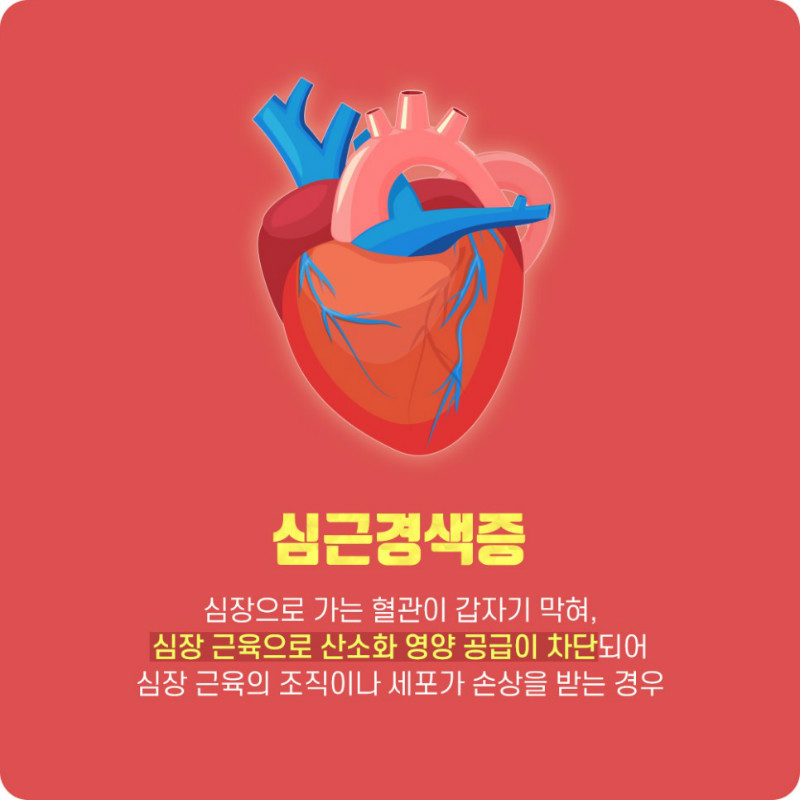 [순환기내과] 심근경색 2.jpg
