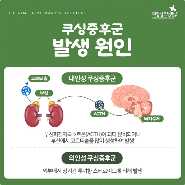 250219_대림성모병원_바이럴_쿠싱증후군_(3).jpg